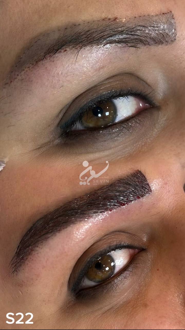 نمونه کاشت ابرو در کلینیک سوین